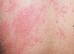 寻麻疹可以吃瓜不